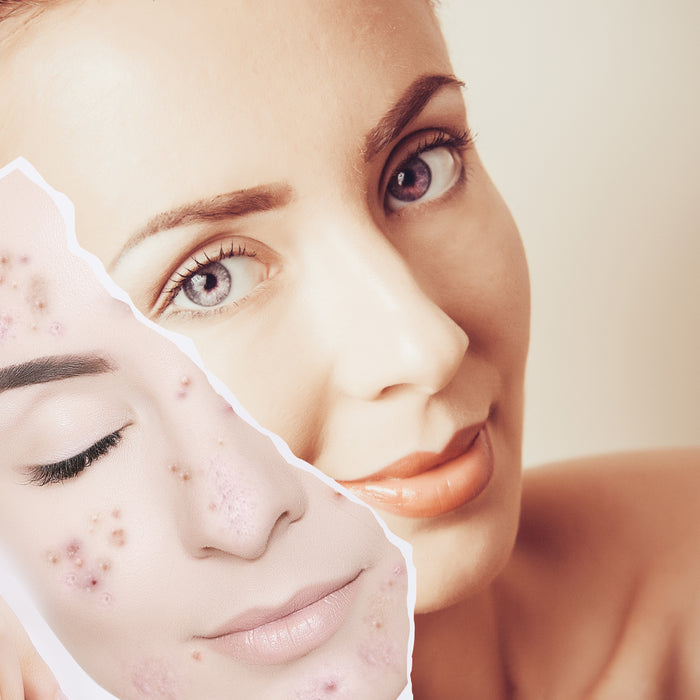 Alpha Hydroxy Acid - (AHA)