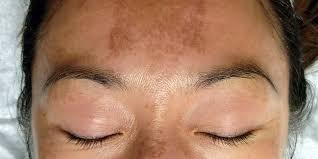 Melasma Skin Condition Products - Atone Skin Clinic