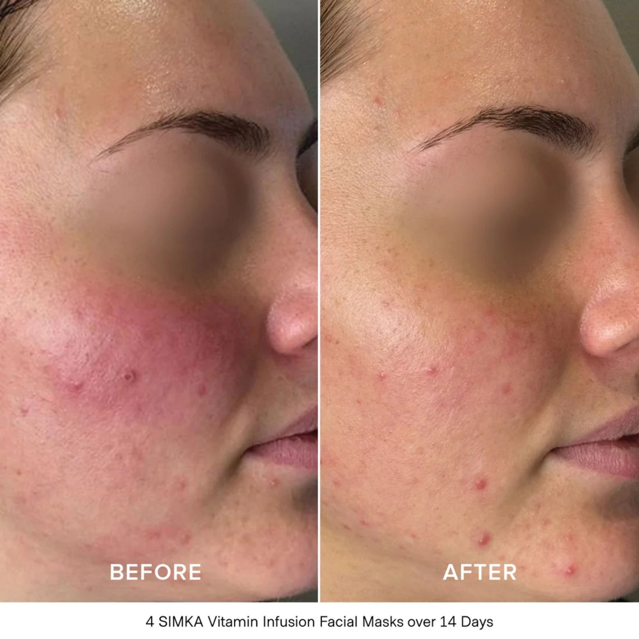Before and after comparison of a person's face with acne treatment showing clear skin.