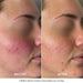 Before and after comparison of a person's face with acne treatment showing clear skin.