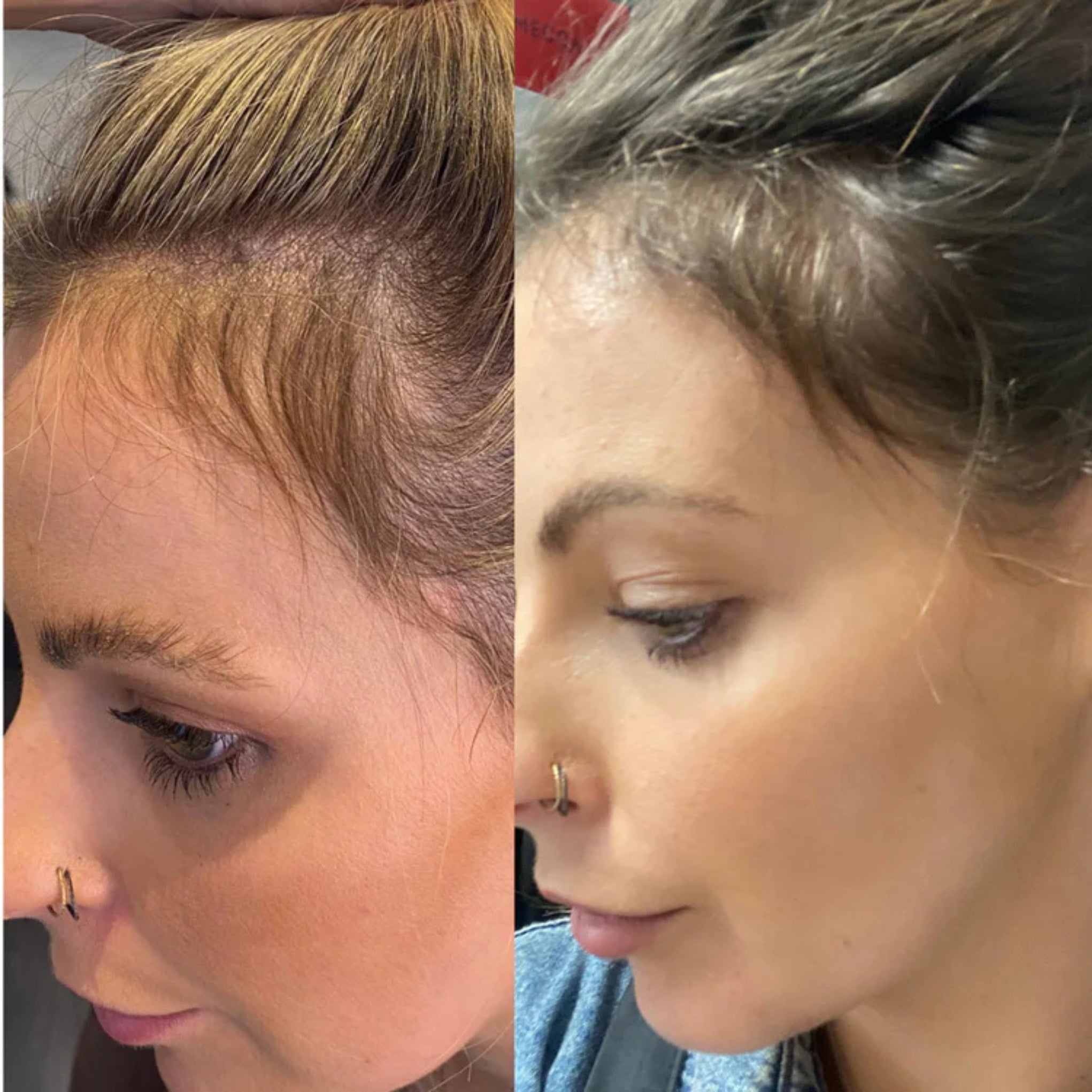 Trudermal HALO LED Hair Growth Cap