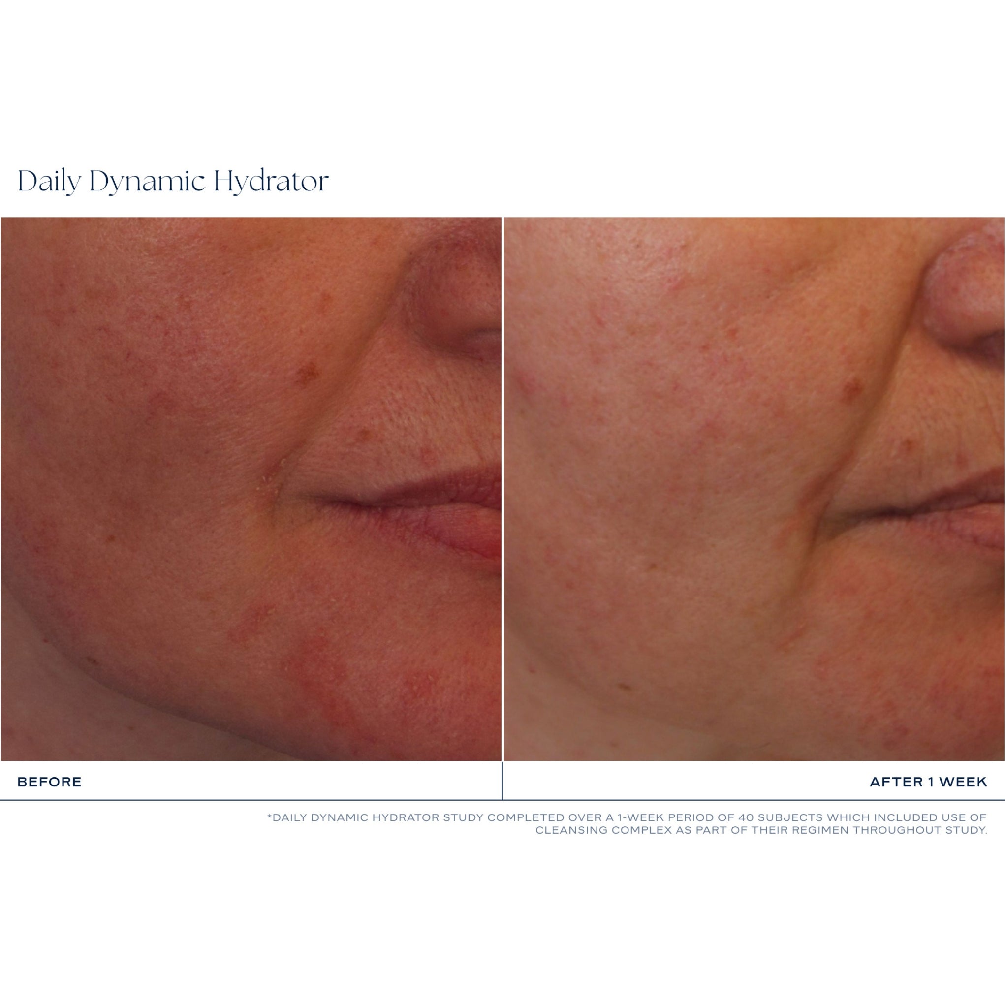 Before and after comparison of skin treatment with iS Clinical's Daily Dynamic Hydrator on a person's face.