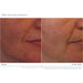 Before and after comparison of skin treatment with iS Clinical's Daily Dynamic Hydrator on a person's face.