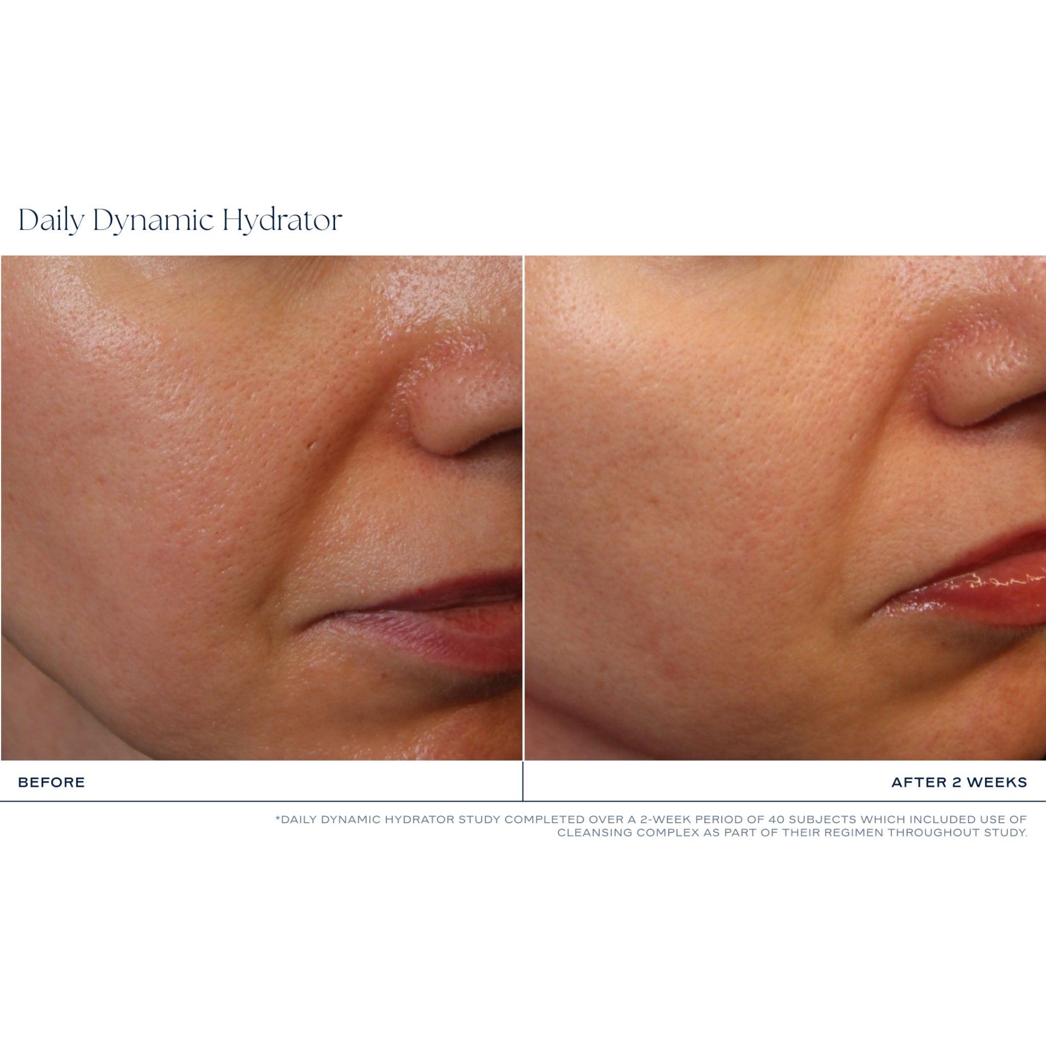 Before and after comparison of a person's skin with iS Clinical's Daily Dynamic Hydrator applies after 2 weeks.