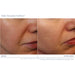 Before and after comparison of a person's skin with iS Clinical's Daily Dynamic Hydrator applies after 2 weeks.