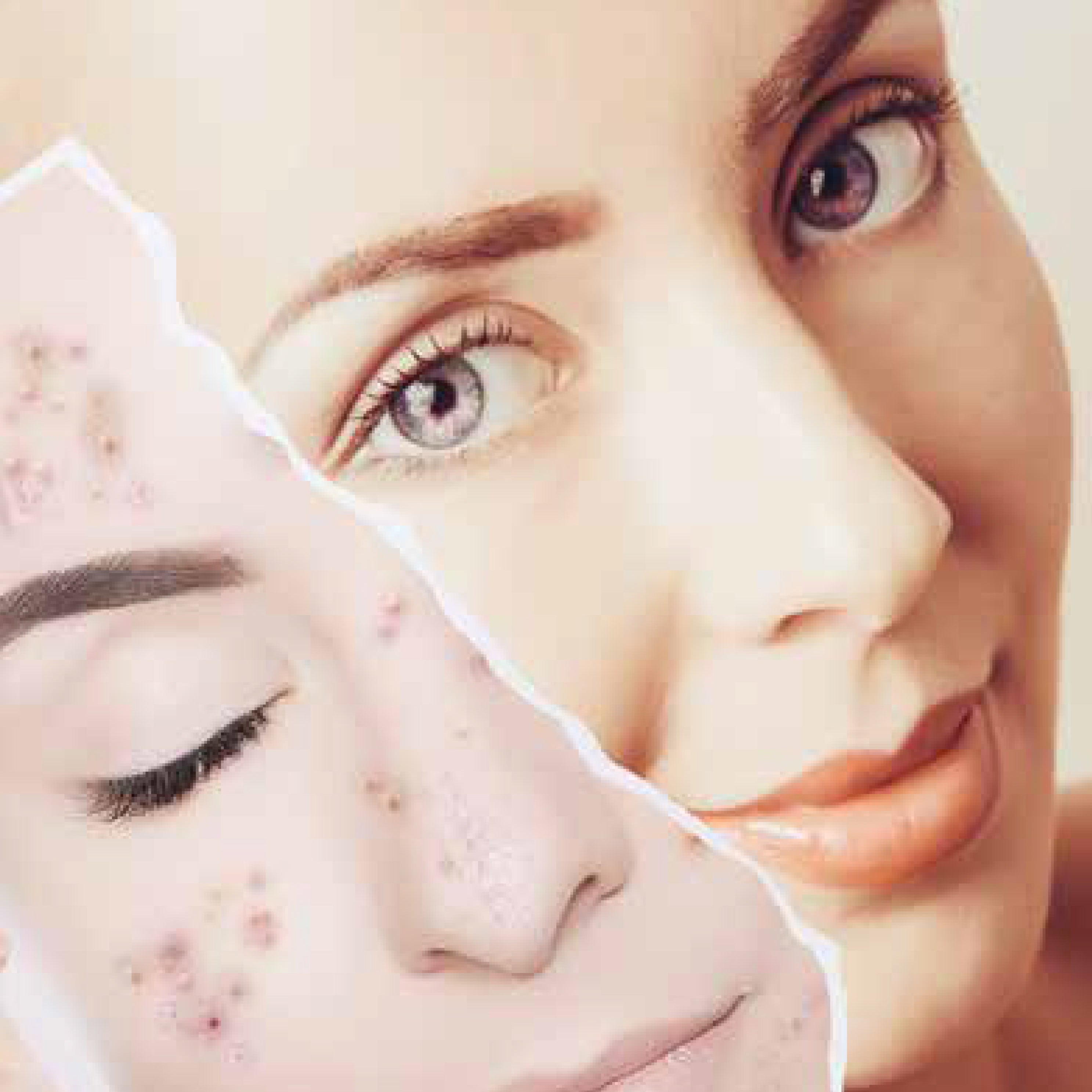 2 x IPL Skin Treatment Face - Neck - Decolletage